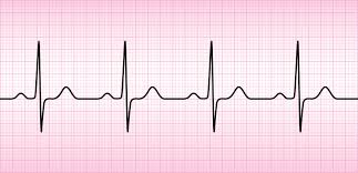 ECG, ou Electro Cardiogramme, IMM
