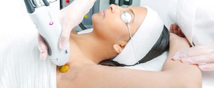Épilation au laser Laser et Sens